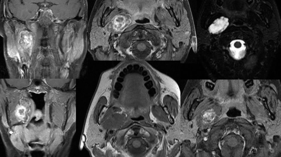 benign mixed tumor parotid